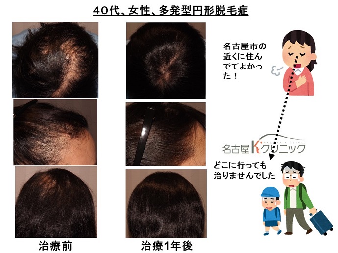 円形脱毛症　病院